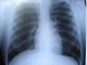 Radiografii pulmonare gratuite pentru bucureșteni