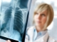 În România mor zilnic 28 de oameni din cauza cancerului pulmonar