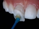 Fațetele dentare - Beneficii și dezavantaje